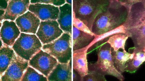 Normal cells (left) compared to when the cell ties are broken down (right). Credit: Vaughan et al. Cell Reports.