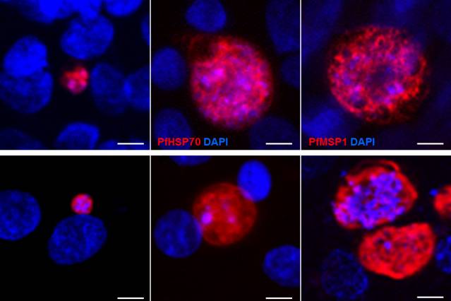 MIT researchers engineered liver-like cells that can be infected with several strains of the parasite that causes malaria, including Plasmodium falciparum (top row) and Plasmodium berghei (bottom row). The red stain reveals parasite infection.