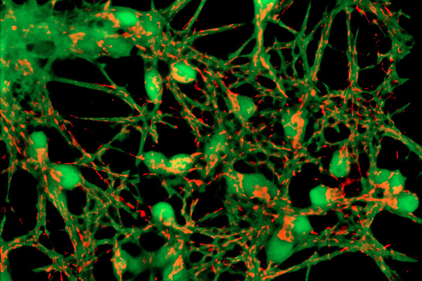 New Understanding of Alzheimer’s