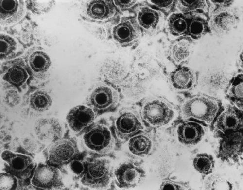 Herpes simplex virus. Credit: CDC