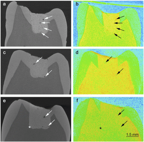 New research into materials for tooth fillings