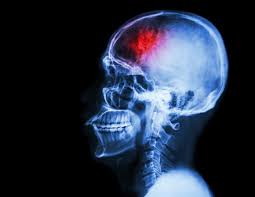 Biologists identify brain tumor weakness