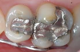 dental amalgam