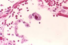 How cells are foiled by…