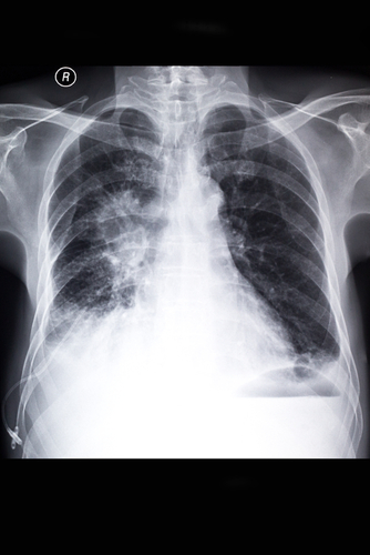 Lung Cancer Clinical Trial Finds&hellip;