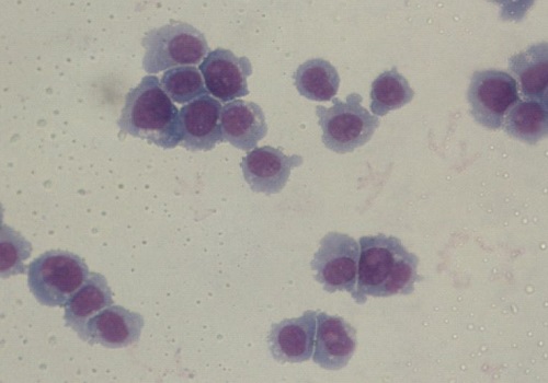 New leukemia treatment offers hope
