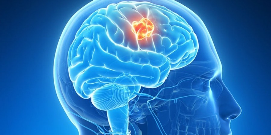 Illustration of a brain tumor Shutterstock