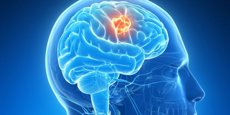 Brain Cancer Now Leading Childhood Cancer Killer