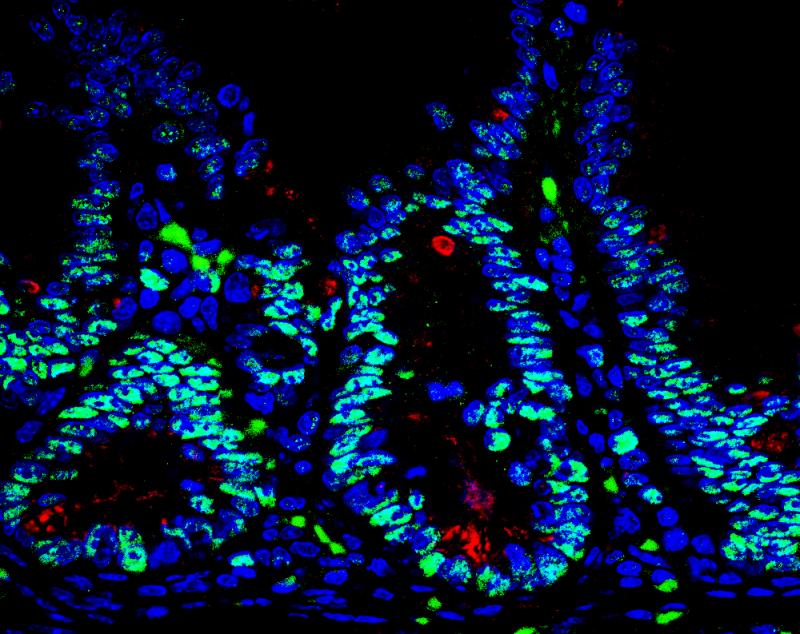 New Therapeutic Target for Crohn’s Disease