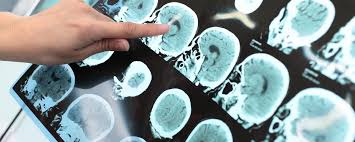 Alzheimer’s Drug Early-Stage Results Met&hellip;