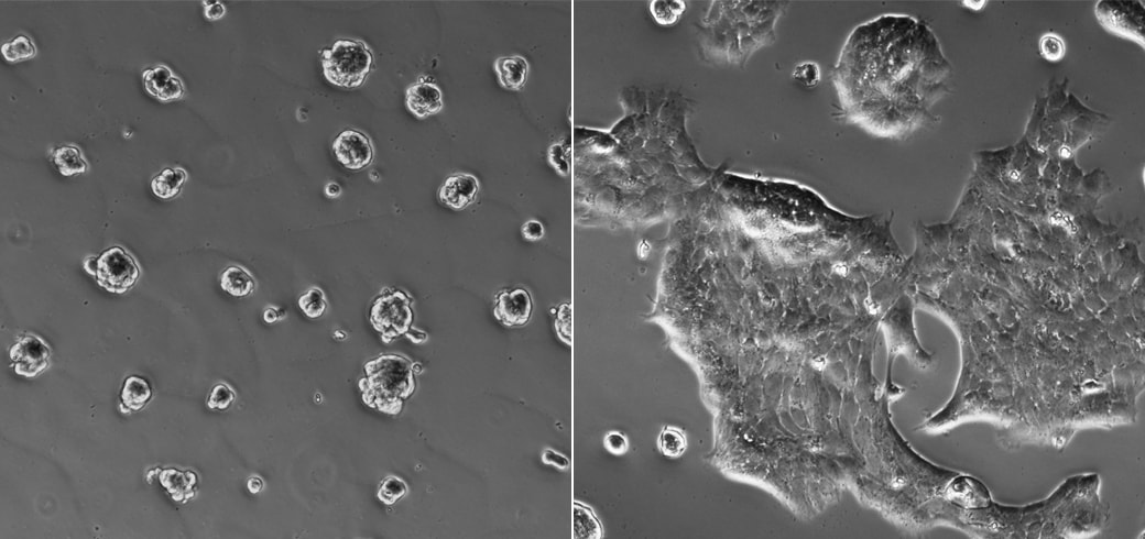 Stiff and Oxygen-Deprived Tumors Promote Spread of Cancer