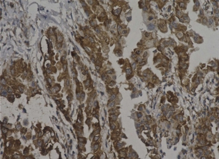 IL-34: a new, possible target to tackle drug-resistant cancer cells