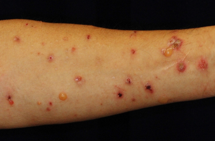 A risk factor for drug-induced…