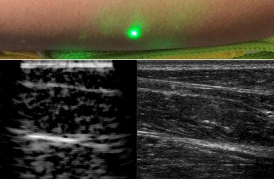 MIT Laser Ultrasound 1