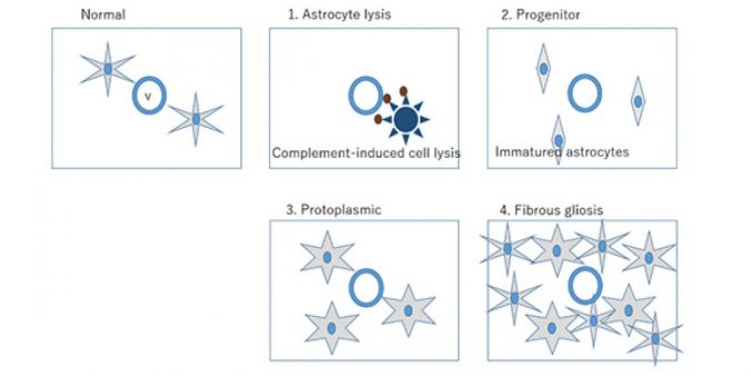 Classification Scheme Developed for Newly Identified Multiple Sclerosis-like Disease 2 research misu nmosd