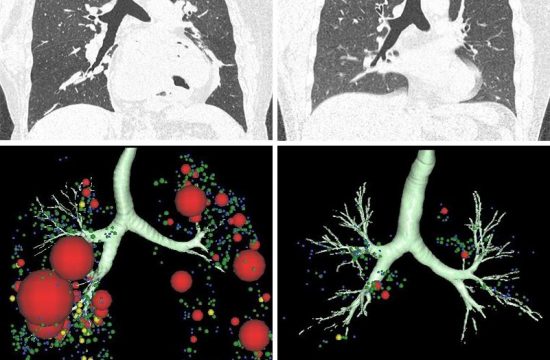 lung CT scans 3D models