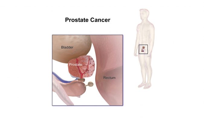 Prostate Cancer