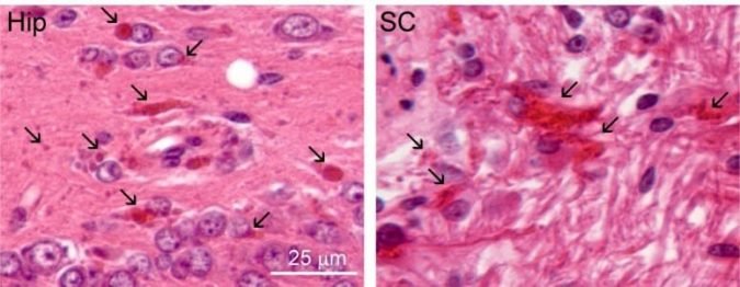 Promising treatment for Alexander disease moves from rat model to human clinical trials 2 Rosenthal Fibers