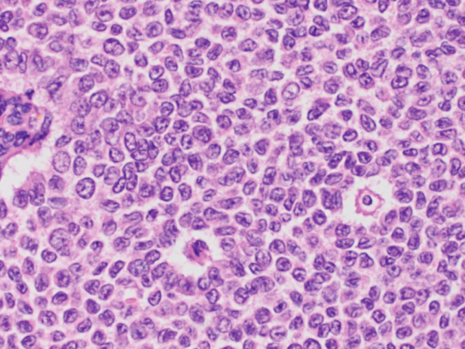 Cancer registry improves understanding of rare ovarian tumor 2 overian