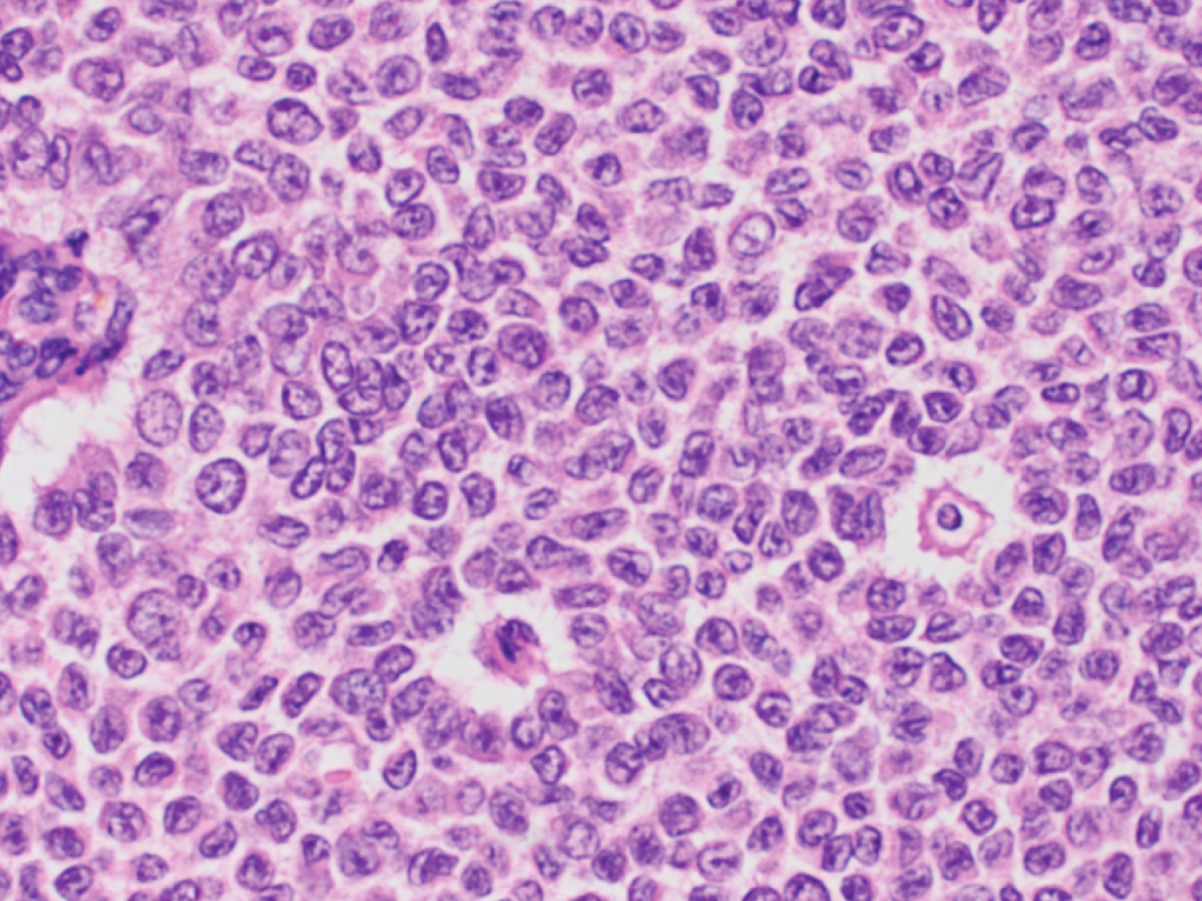 Cancer registry improves understanding of…