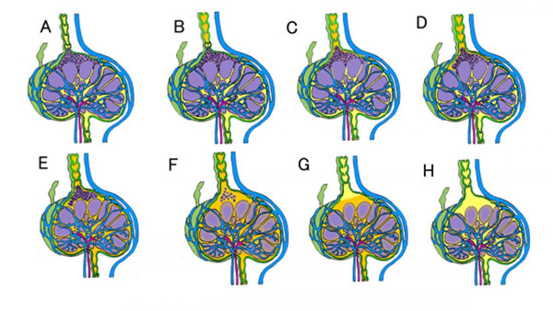 Osmotic Pressure and ViscosityAnticancer Drug Efficacy and Restricting Tumors Using LDDS
