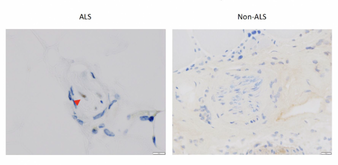 Accumulation of TDP 43 with ALS patients