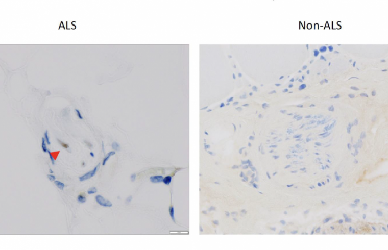 Accumulation of TDP 43 with ALS patients