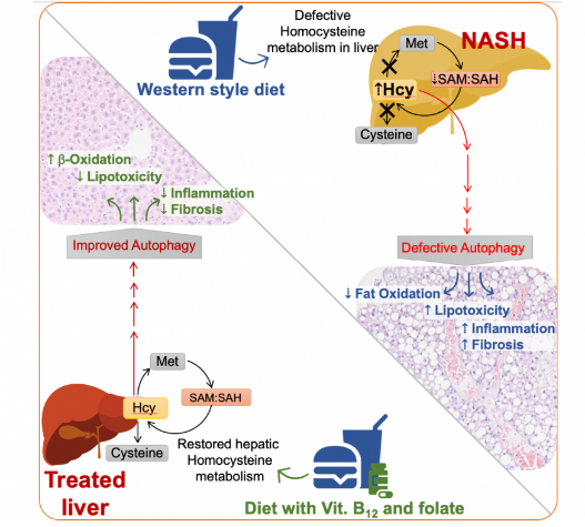 B vitamins can treat advanced non-alcoholic fatty liver…