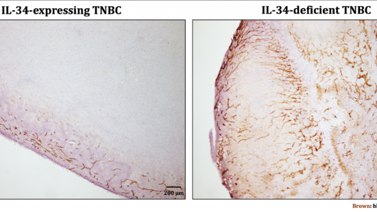 il 34 expressing tnbc