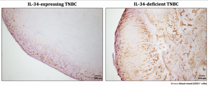 il 34 expressing tnbc