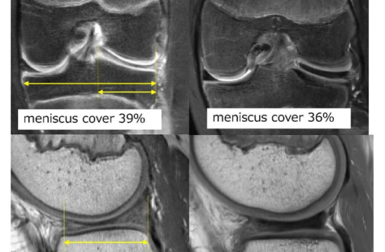 meniscus disconfort