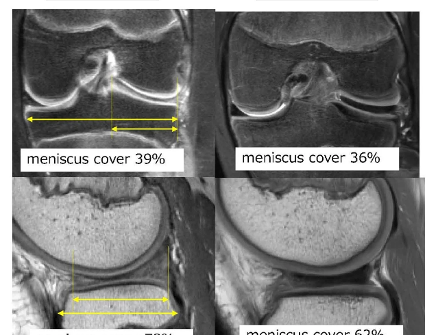 meniscus disconfort
