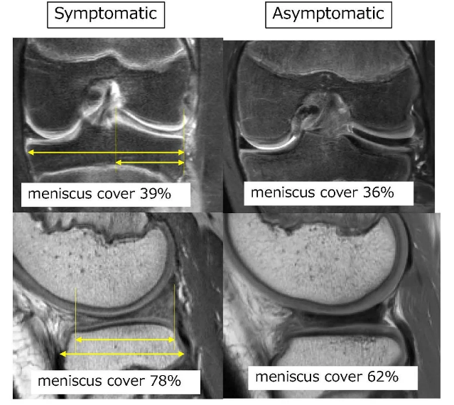 The size of your meniscus matters: an explanation of knee discomfort