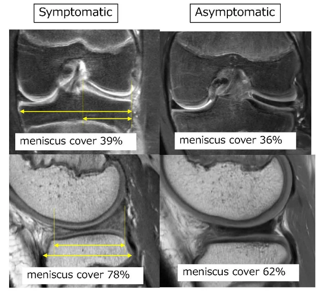 The size of your meniscus matters: an explanation of knee discomfort