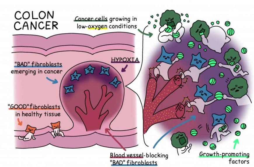 Oxygen deprivation promotes colon cancer…