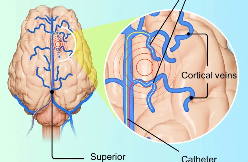 New Brain Monitoring Method Could Change Epilepsy Treatment