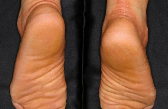 Sniffing out the cause of keratoderma-associated foot odor 3 nagashima type palmoplantar keratosis