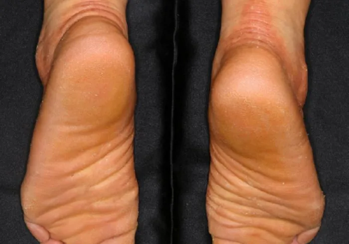 nagashima type palmoplantar keratosis