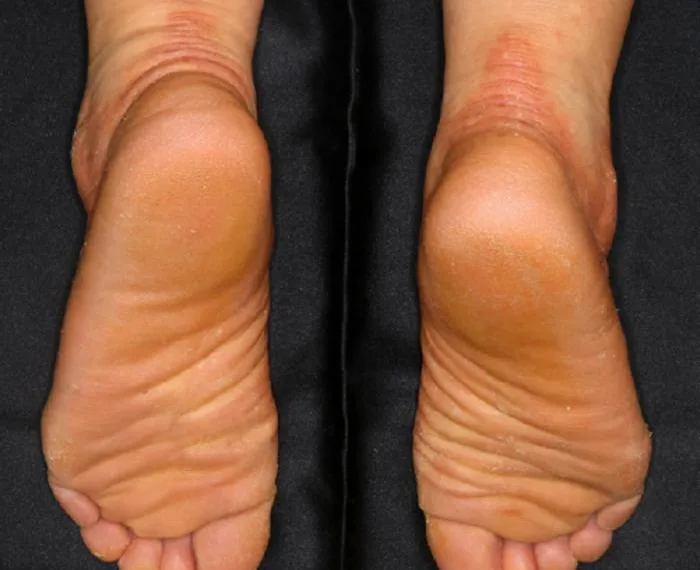 Sniffing out the cause of keratoderma-associated foot odor