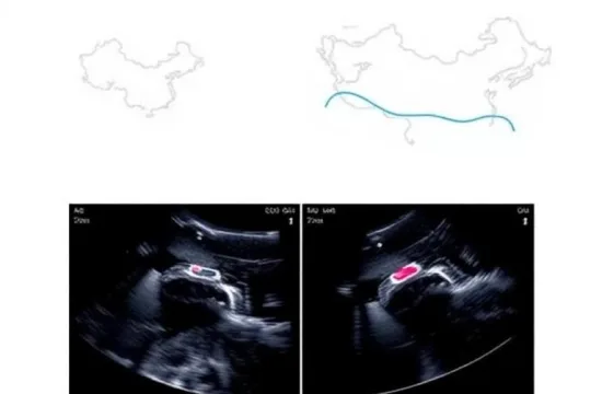 AI assisted ultrasound for artery plaque